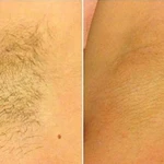 Шугаринг - депиляция нежелательных волос