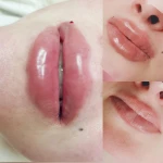 Фото №2 Аугментация губ 