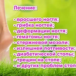 Фото №2 Вросший ноготь. Грибок ногтей. Стержневые мозоли. Избавление от этих проблем