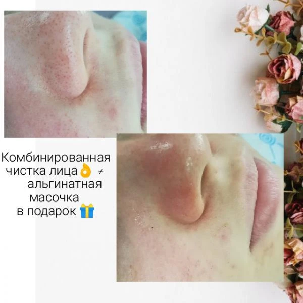 Фото Ультразвуковая чистка лица 