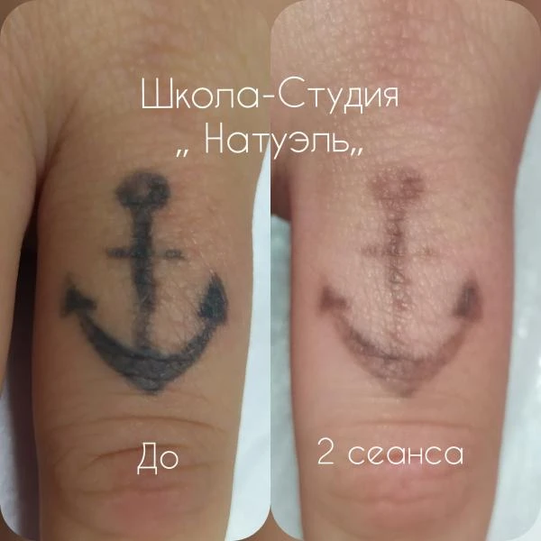 Фото Удаление татуировок(татуажа перманента)