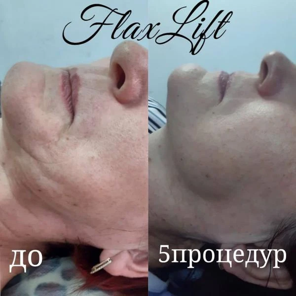 Фото Эстетическое омоложение лица