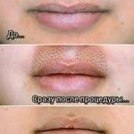 Фото №9 Омоложение без инъекций