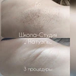 Фото №2 Лазерная Эпиляция.
