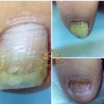 Лечение грибка и вросших ногтей