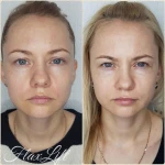 Фото №2 Эстетическое омоложение лица