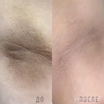 Фото №5 Косметолог / Чистка лица/ Пилинг/Мезопилинг