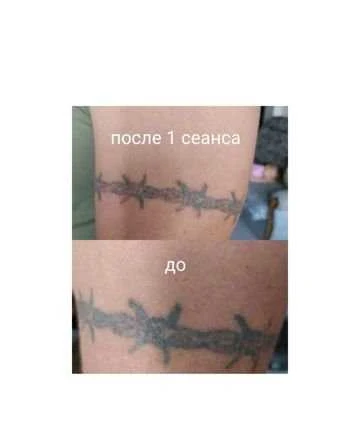 Фото Удаление тату, татуажа
