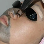 Карбоновый пилинг