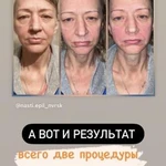 Фото №8 Массаж лица