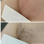 Шугаринг эпиляция