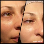 BB GLOW TREATMENT