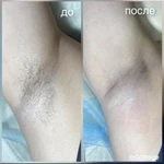 Фото №5 Депиляция