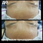 Фото №4 Омоложение без уколов
