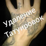 Удаление татуажа татуировок