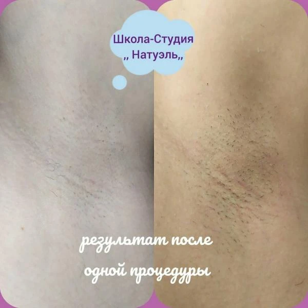 Фото Лазерная Эпиляция.