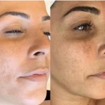 Фракционная мезотерапия