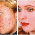 Фото №4 Лечение аппаратом Bioptron РRО