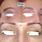 Фото №2 Лазерная шлифовка верхнего и нижнего века на DEKA CO2 (Италия)