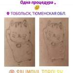 Фото №3 Удаление татуировок татуажа