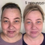Фото №3 Эстетическое омоложение лица