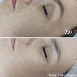 Карбокситерапия 