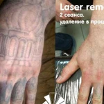 Лазерное удаление тату (перманентного макияжа)