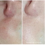 Элос омоложение