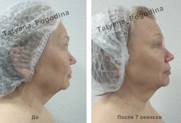 Фото Лифтинговый массаж лица