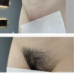 Шугаринг эпиляция