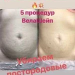 Коррекция фигуры VelaShape