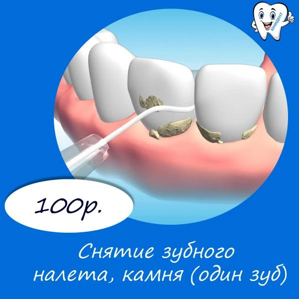 Фото Снятие зубного налета, камня (один зуб