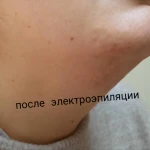 Фото №4 Электроэпиляция 