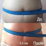 Фото №7 Лазерная Элос- эпиляция, RF лифтинг, массаж лица