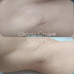Фото №3 Лазерная Эпиляция.
