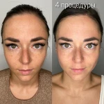 Фото №5 Эстетическое омоложение лица
