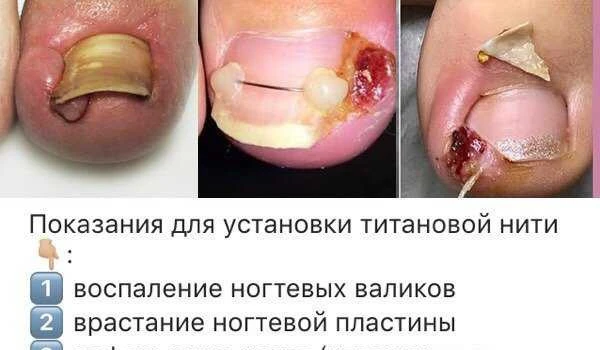 Фото Титановые нити, установка