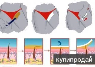 Фото депиляция-шугаринг,для тех кому надоело бриться