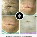 Фото №5 Омоложение без инъекций