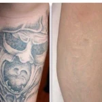 Удаление татуировок и татуажа