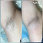 Фото №9 Депиляция