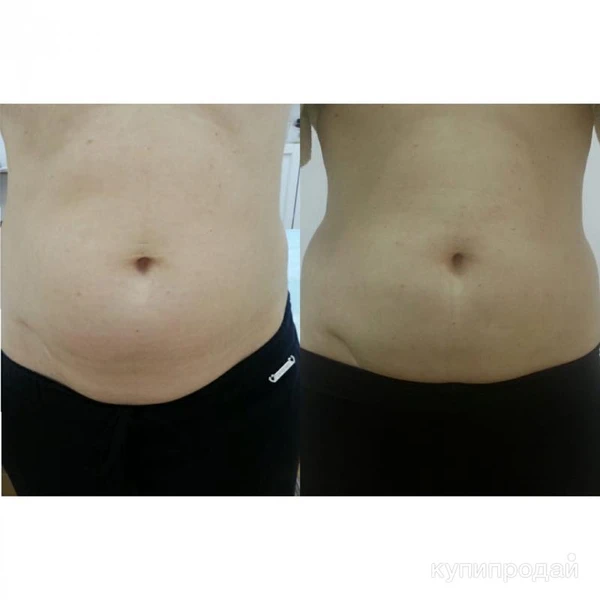 Фото Косметолог / Чистка лица/ Пилинг/Мезопилинг