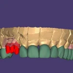 Проектирование работ в exocad, стоматология