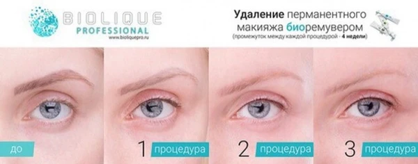 Фото Биоремувер. Удаление татуажа. 
