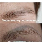 Лазерное удаление некачественного татуажа