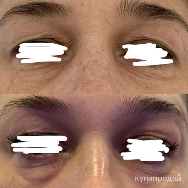 Фото Лазерная шлифовка верхнего и нижнего века на DEKA CO2 (Италия)